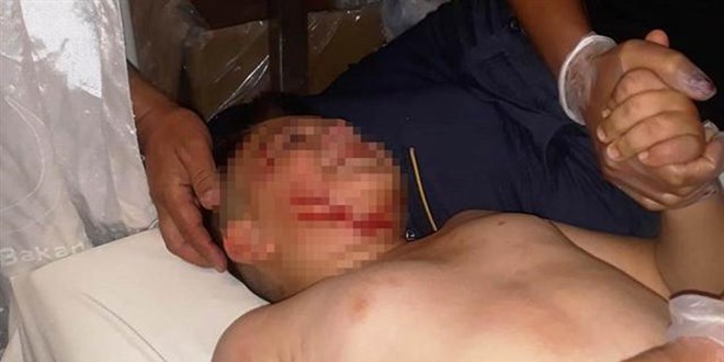 Sokak köpeğinin saldırdığı çocuğa 40 dikiş atıldı