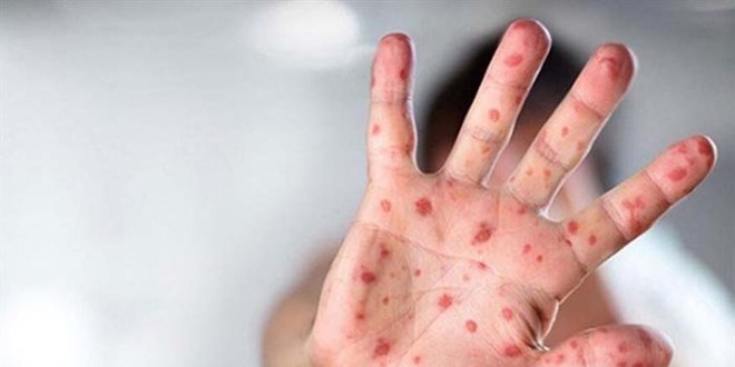 Dünya genelinde maymun çiçeği vakaları 70 bini aştı