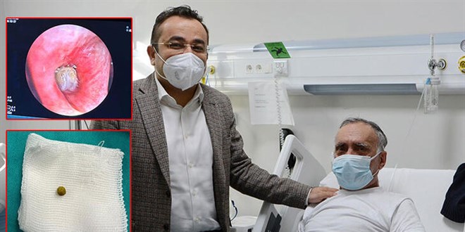Akciğerine kaçan bezelye ameliyatla çıkarıldı