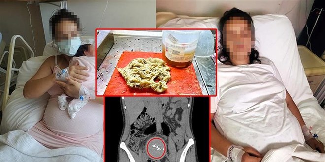 Doğumda annenin vücudunda unutulan gazlı bez, 2 yıl sonra fark edildi