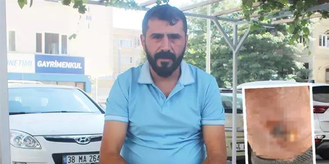 Yanlış sülük tedavisi hayatını kararttı! 2 aydır işe gidemiyor