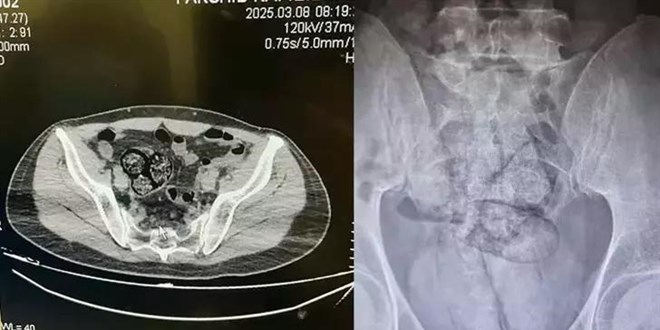 Bağırsağında uyuşturucu taşıyan şüpheli Artvin'de yakalandı