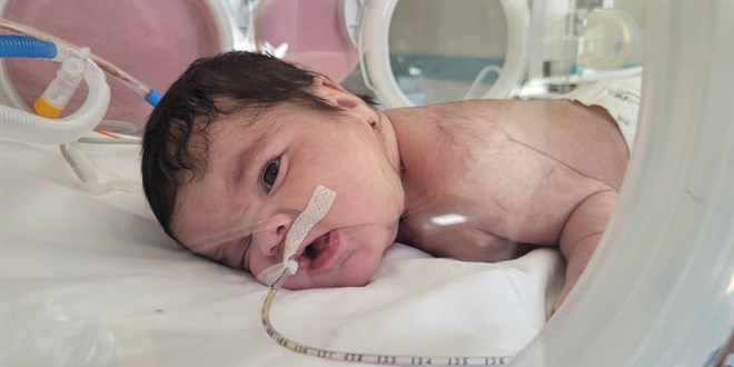 Bir bebeğin boynundan 445 gram tümör çıkarıldı