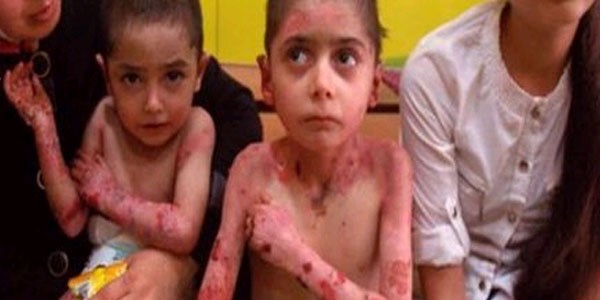 Tekirdağ'da kalıtsal deri hastalığına yakalanan çocuklar