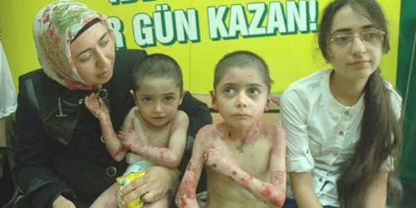 Aydın kardeşlerin tedavisi devam ediyor
