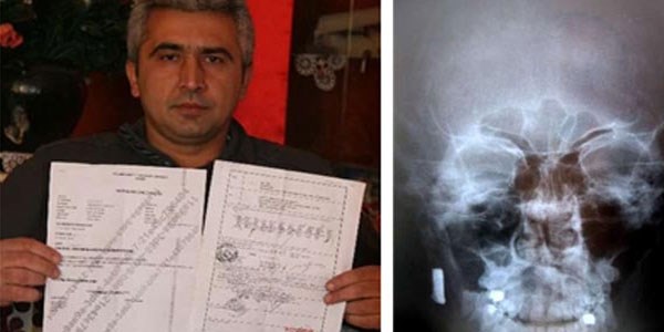 Kafasındaki kurşunla 20 yıl yaşadı