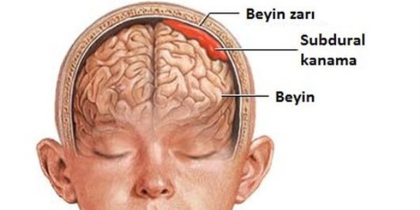 Beyin kanamalarna travma m sebep olur?