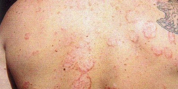 Ünlü profesörden Türklere Lyme hastalığı uyarısı
