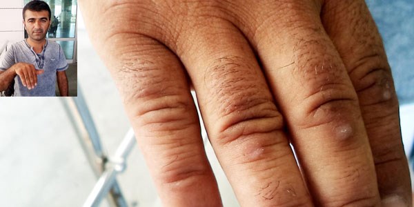 Diş teknisyenine mengeneli işkence iddiası