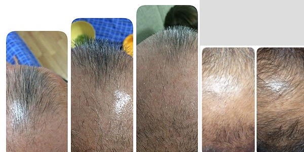 Saç dökülmesine nanoteknolojili çözüm