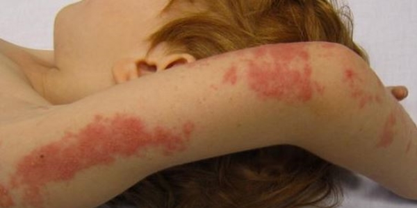 Lupus, tedavi edilmezse ölümcül olabilir