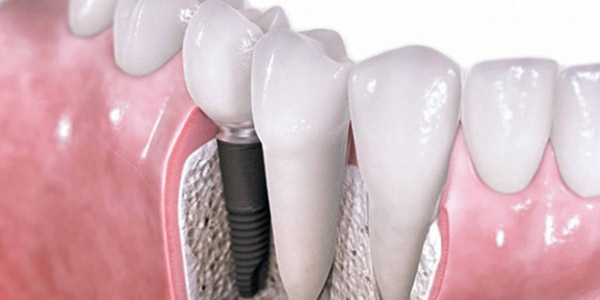 Dikişsiz implant devri