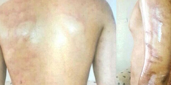 Yanlış epilasyona 1500 lira tazminat