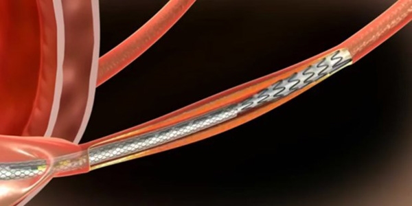 10 soruda stent uygulaması