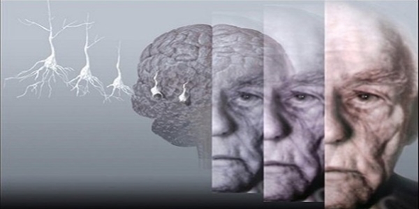Alzheimer 18 yl nce tehis edilebiliyor