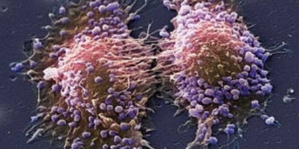 '12 erkekten biri prostat kanserine yakalanıyor'