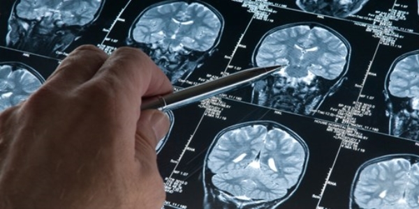 Alzheimer hastalığı ertelenebilir