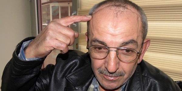 Göz rahatsızlığı için gitti, beyninde tümör çıktı