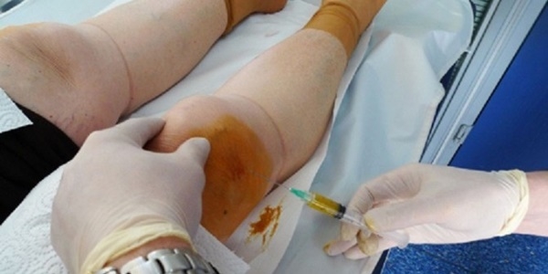 Diz Ağrıları Prp ile tarih oluyor