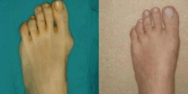 Ayaklarda ağrıyla ortaya çıkan çarpıklığa dikkat