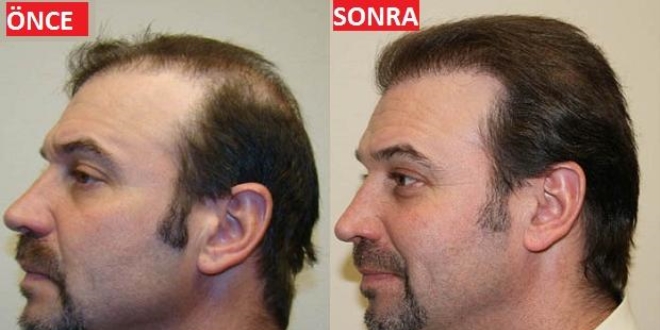 Stres ve genler saçları döküyor