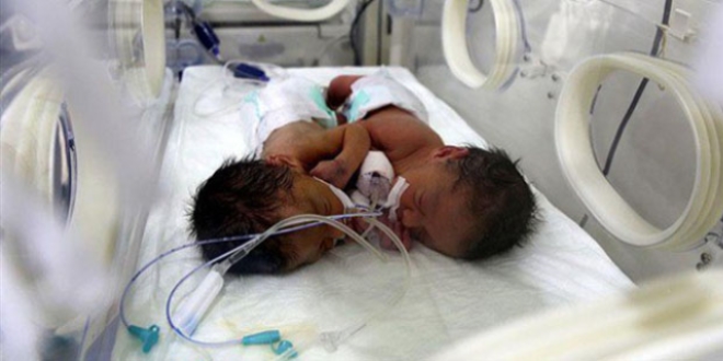 anlurfa'da siyam ikizi bebekler ameliyatla ayrld
