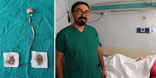 Korkup aldırmadı, 30 santimetre taş oluşturdu