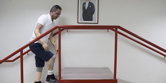 'Elektronik protez' yaşama sevinci oldu