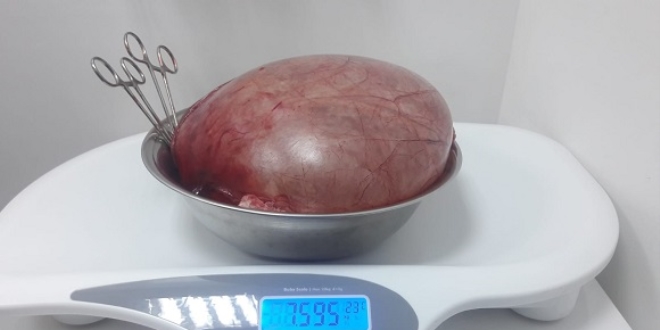 Karnından 7,5 kiloluk kist çıktı