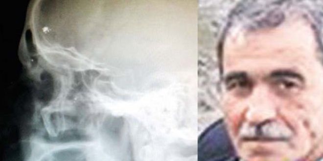 Çatışmada kafasına giren kurşun 40 yıl sonra keşfedildi