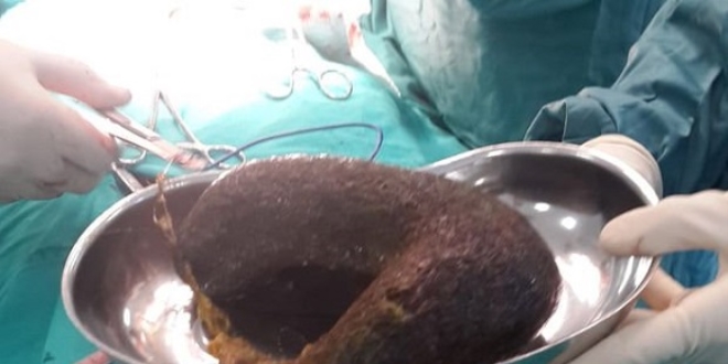 Midesinden 1,5 kilogram saç çıktı