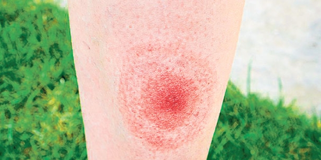 Çağın salgını 'Lyme'