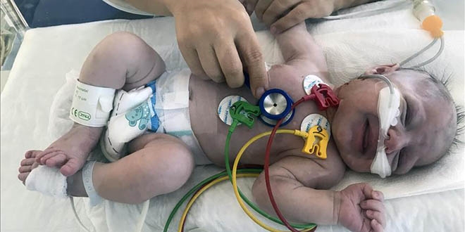 İki günlük Güneş bebeğin damarı stentle açıldı