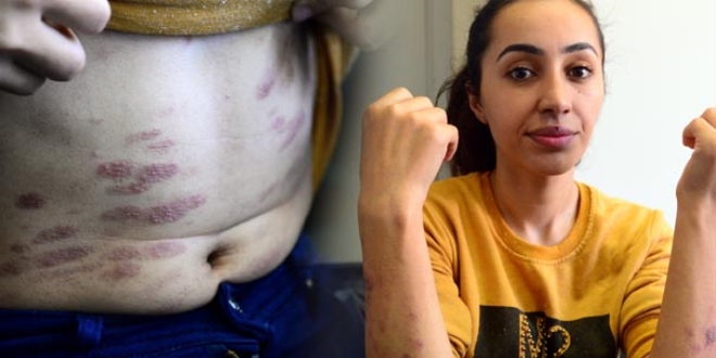 Lazer epilasyonda kabusu yaşadı