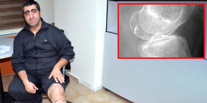 Ameliyatta bacağında tıbbi kamera unutulduğu iddiası