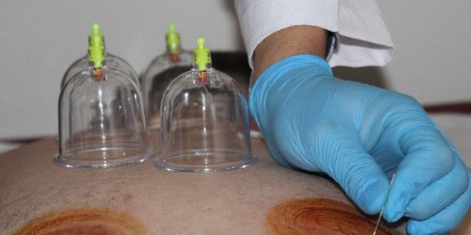 Isparta Şehir Hastanesi'nde hacamat tedavisi dönemi