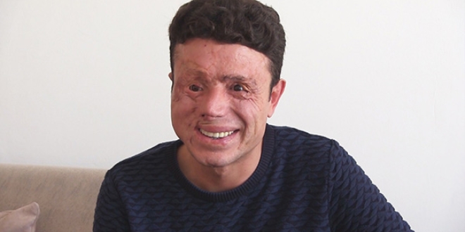 Gözlerini ve yüzünü kaybetti, gülüşünü kaybetmedi