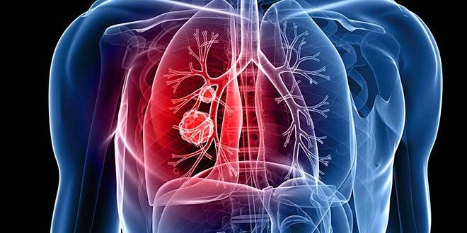 Kanserin bir numaralı ölüm sebebi olduğu yaş grubu