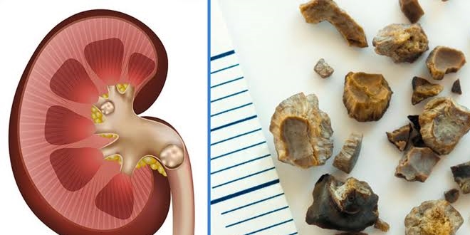 Böbrek taşı en sık 30'lu yaşlarda görülüyor