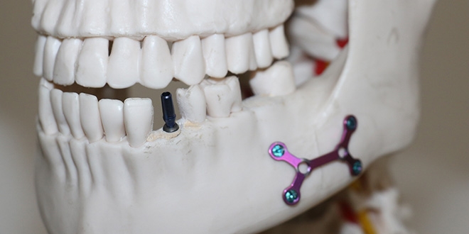 Türk firması, diş implantında dışa bağımlılığa son verdi