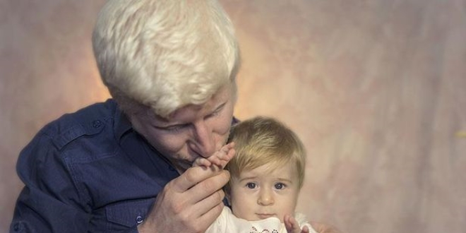Albinizm hastas niversite okuyabilmek iin engel tanmad
