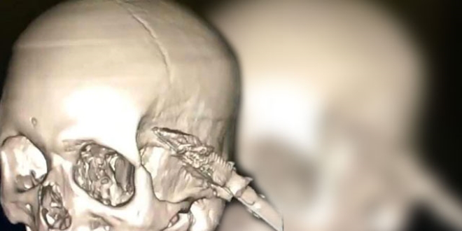 Bir garip olay! Uyurken düştü, kafasına soba maşası girdi