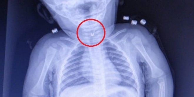7 aylık bebeğin yemek borusundan çengelli iğne çıktı