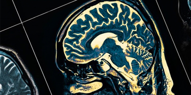 Bilim insanlarından Alzheimer'ın tedavisinde çığır açan buluş