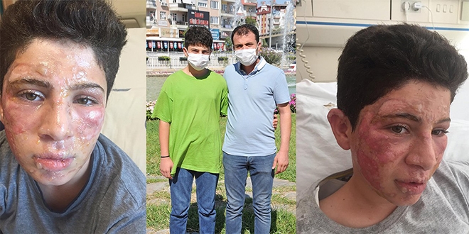 Okul'da yüzü yanan oğlu için hukuk mücadelesi başlattı