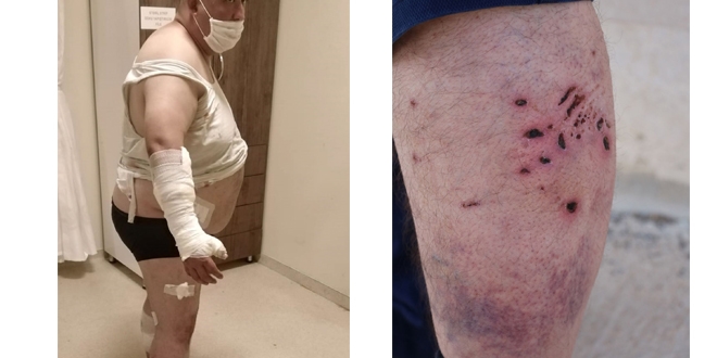 Pitbull cinsi köpekler tatilciye cehennemi yaşattı