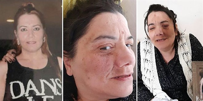 Damak tedavisinde sinir kesilince yüz felci oldu
