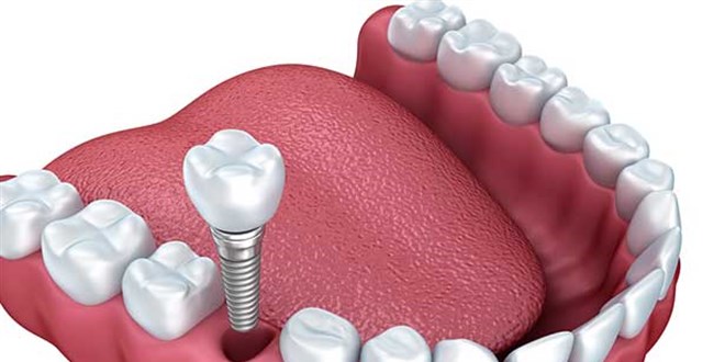 Güney Kore menşeli 'implantlar' için damping soruşturması açıldı