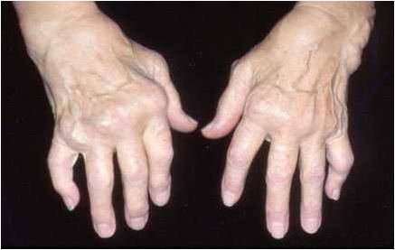 dureri articulare sub degetul mare