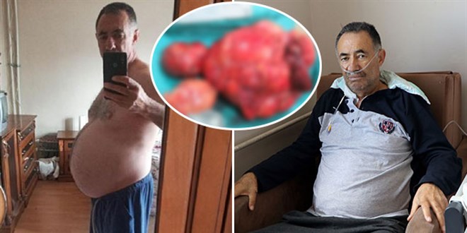 Kilo şikayetiyle doktora gitti, karnından 35 kilo tümör çıkarıldı